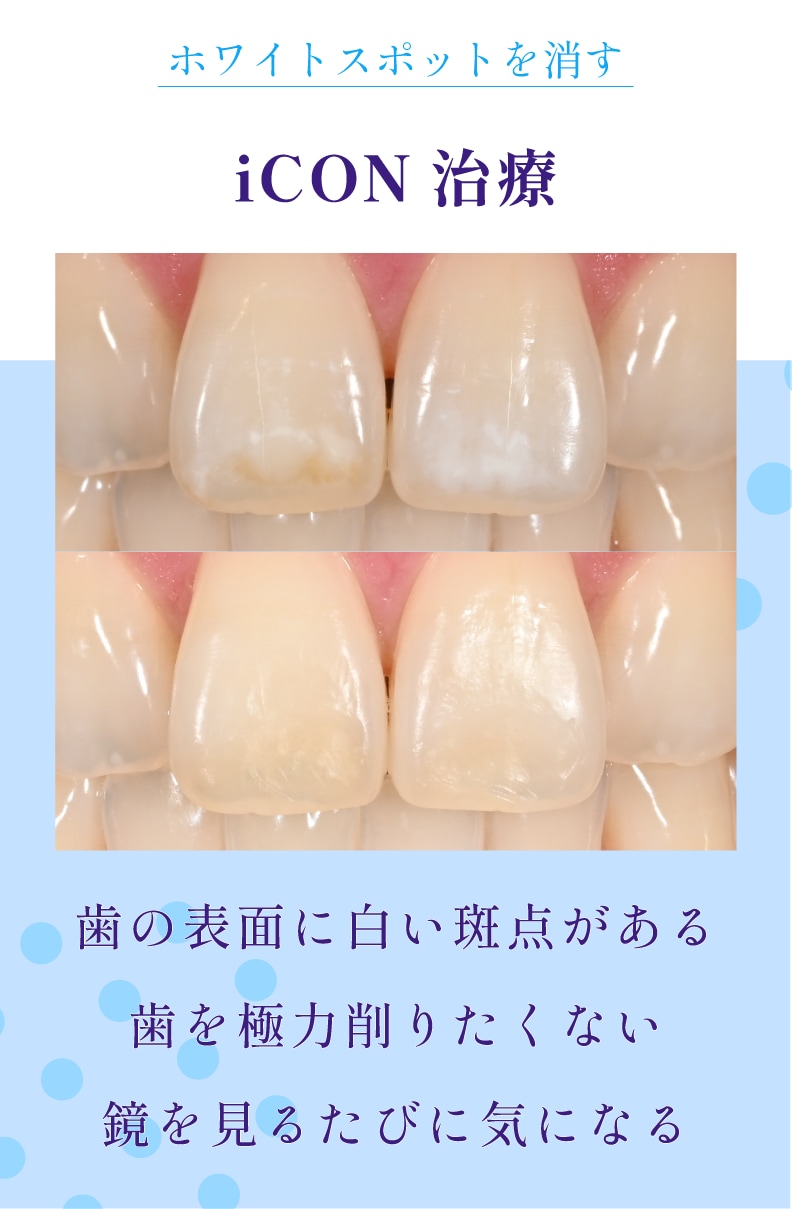 【白い斑点】ホワイトスポット治療で大きく削らず治す